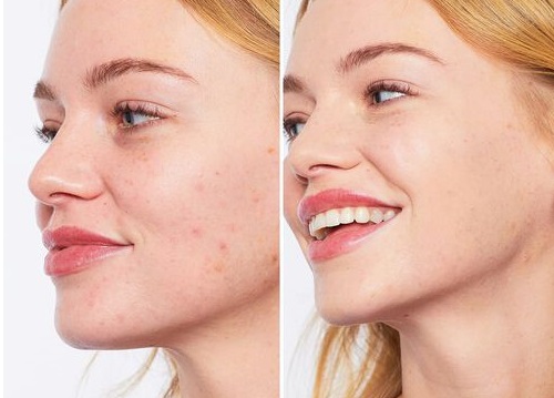 قبل و بعد استفاده از کرم هلو آنوا