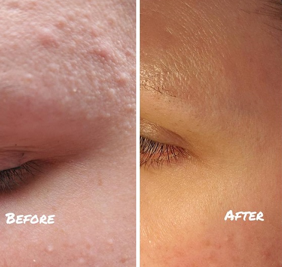 قبل و بعد استفاده از سرم سالیسیلیک اسید اوردینری