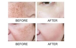 قبل و بعد استفاده از سرم نیاسینامید انوا