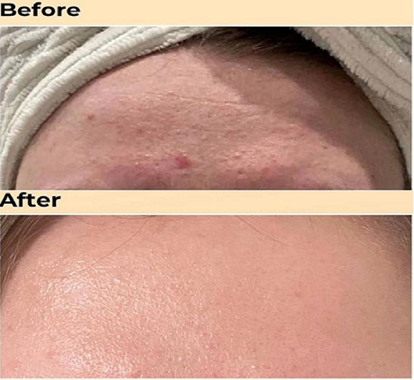 قبل و بعد استفاده از اسنس حلزون